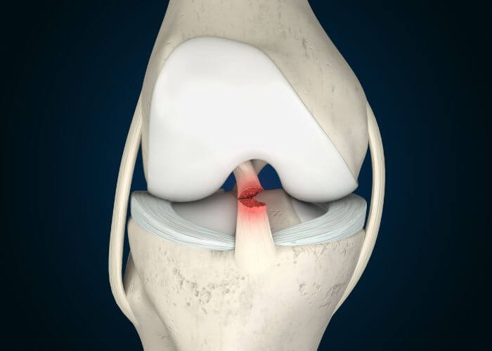 ACL Tear Treatment in Jaipur under RGHS, Private & Insurance – Complete 2025 Guide